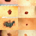 pag10_Melanoma_vs_normal_mole_ABCD_rule_NCI_Visuals_Online