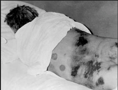 Allarme zecche in Spagna: primi casi di virus Crimea Congo